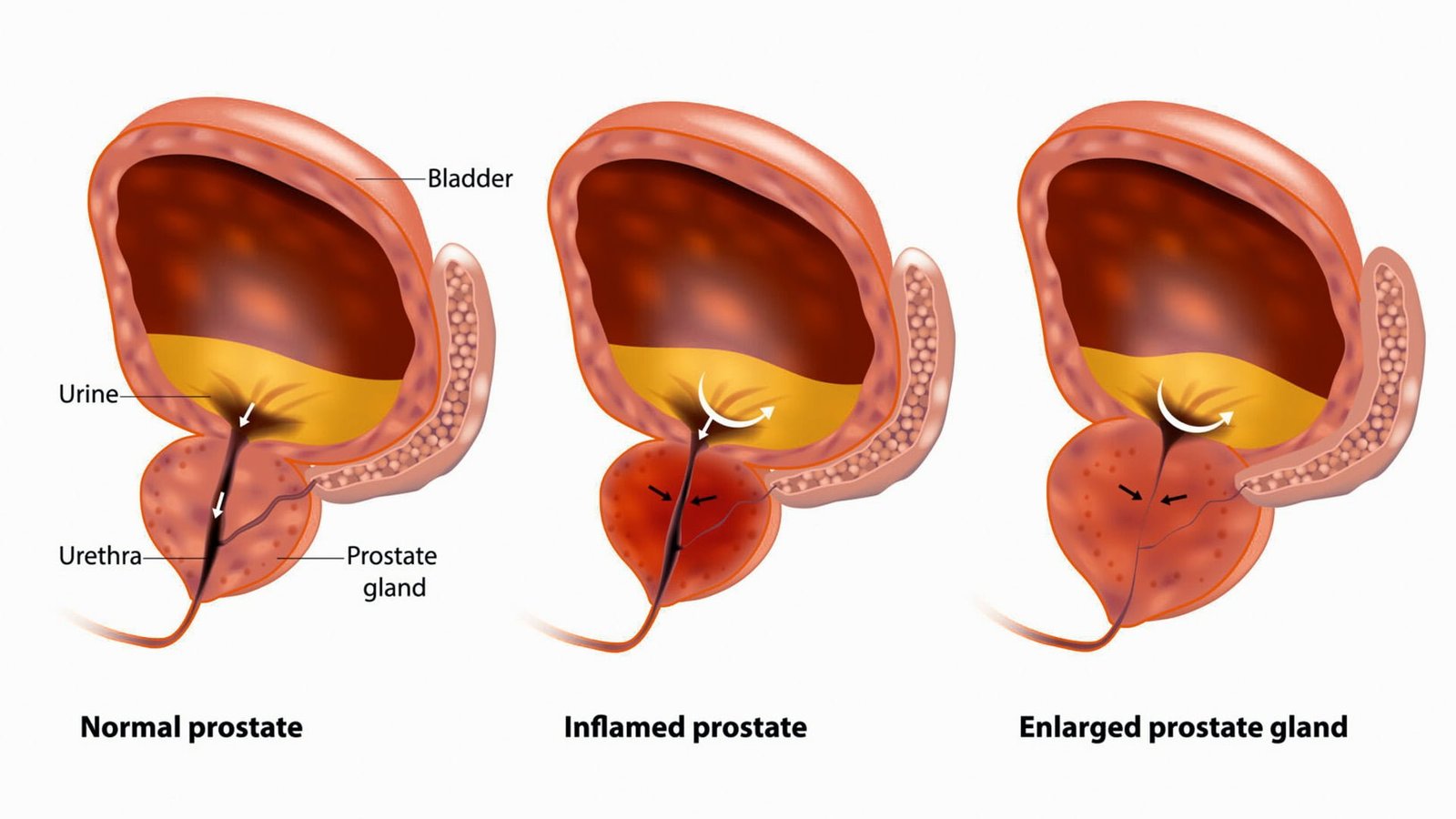 chronic prostate