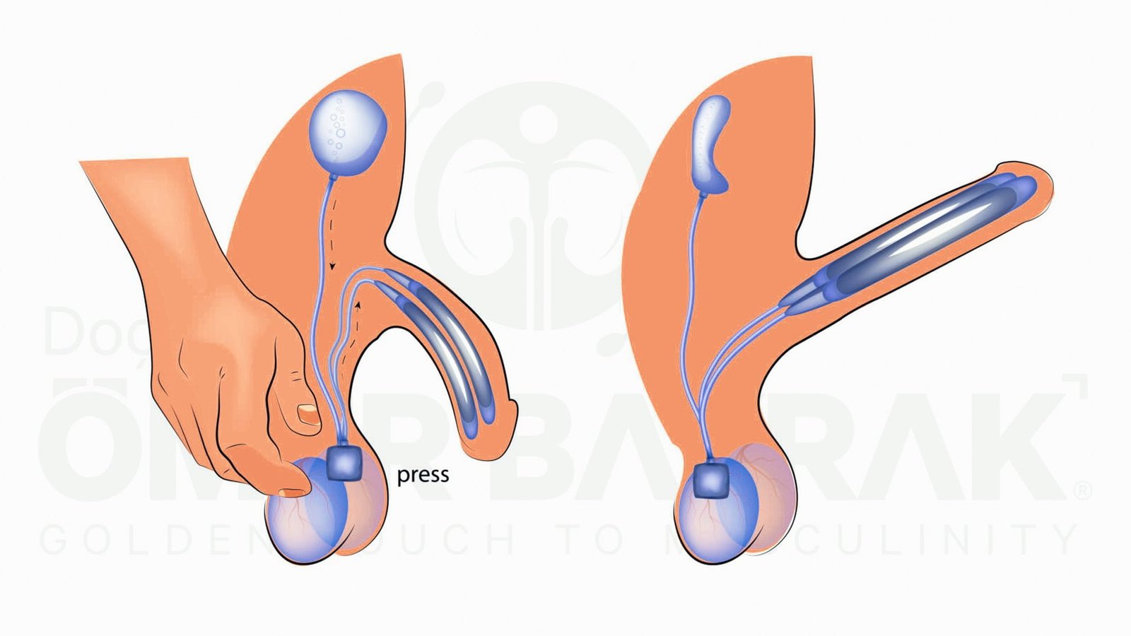 three-piece penile prosthesis